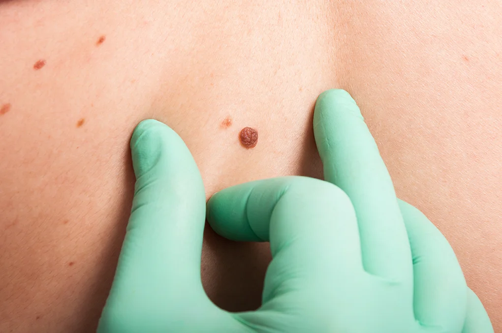 Skin Checks